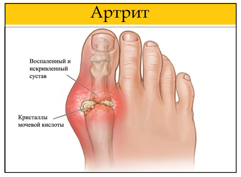 Артрит суставов пальцев ног психосоматика, причины