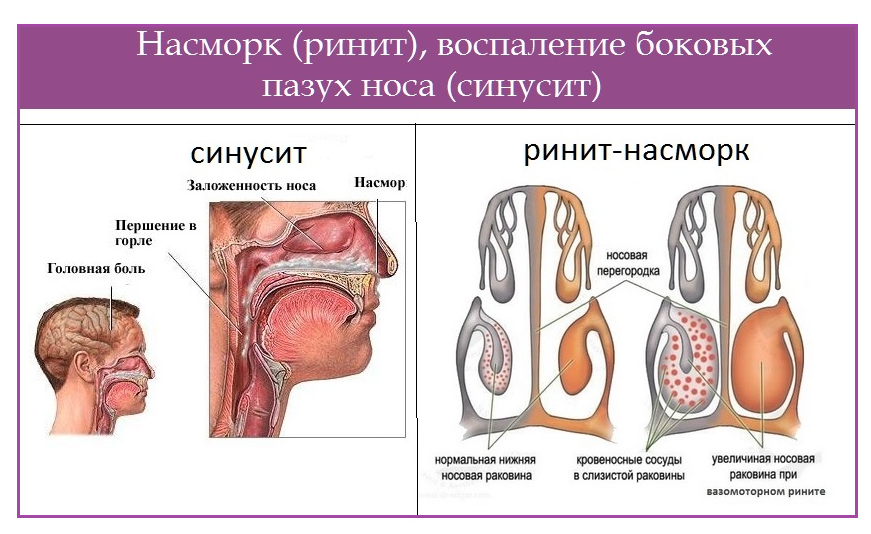 Риноскопическая картина при аллергическом рините