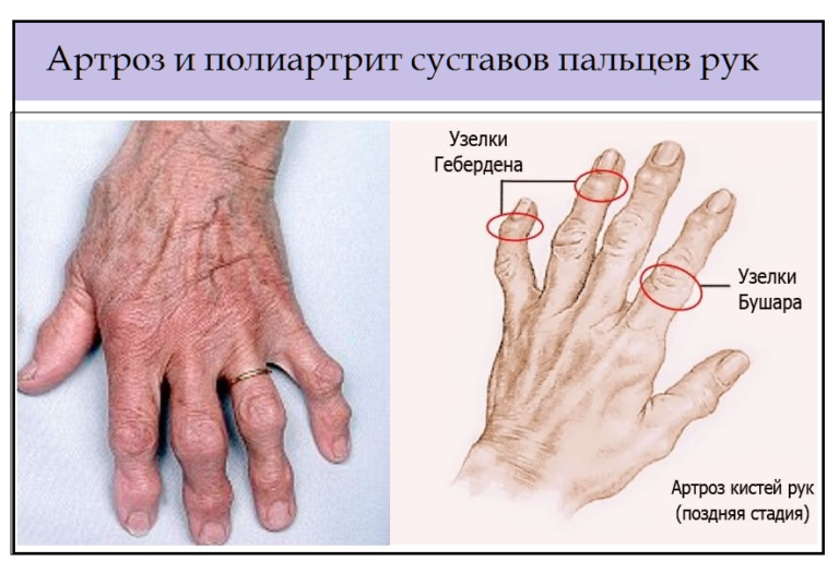 Артроз суставов рук психосоматика причины, примеры