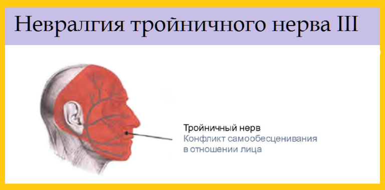 Невралгия тройничного нерва психосоматика, примеры