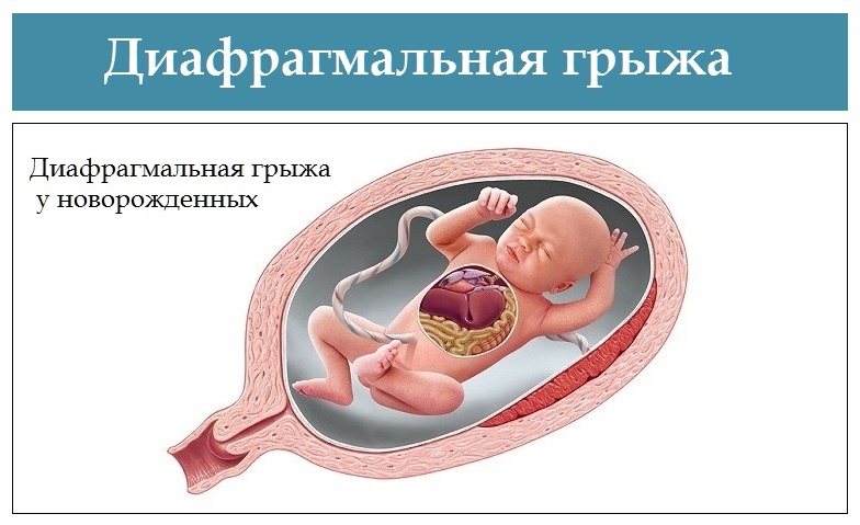 Диафрагмальная грыжа. Врожденная диафрагмальная грыжа. Левосторонняя диафрагмальная грыжа. Диафрагмальная грыжа у плода. Диафрагмальная грыжа у новорожденного рентген.