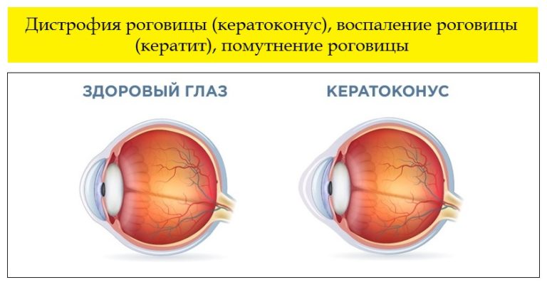Дистрофия роговицы глаза психосоматика, причины