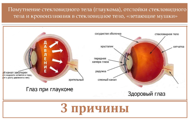 Глаукома и катаракта одновременно психосоматика, причины