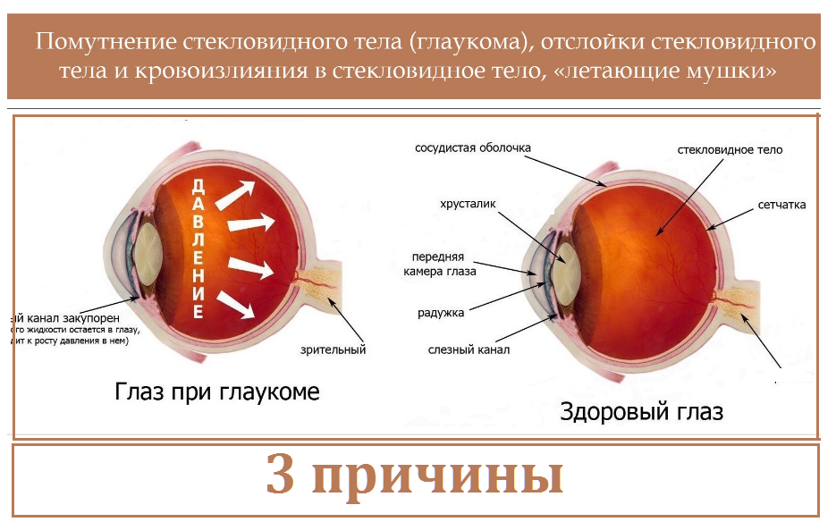 Заболевание глаз глаукома. Глаукома схема глаза.