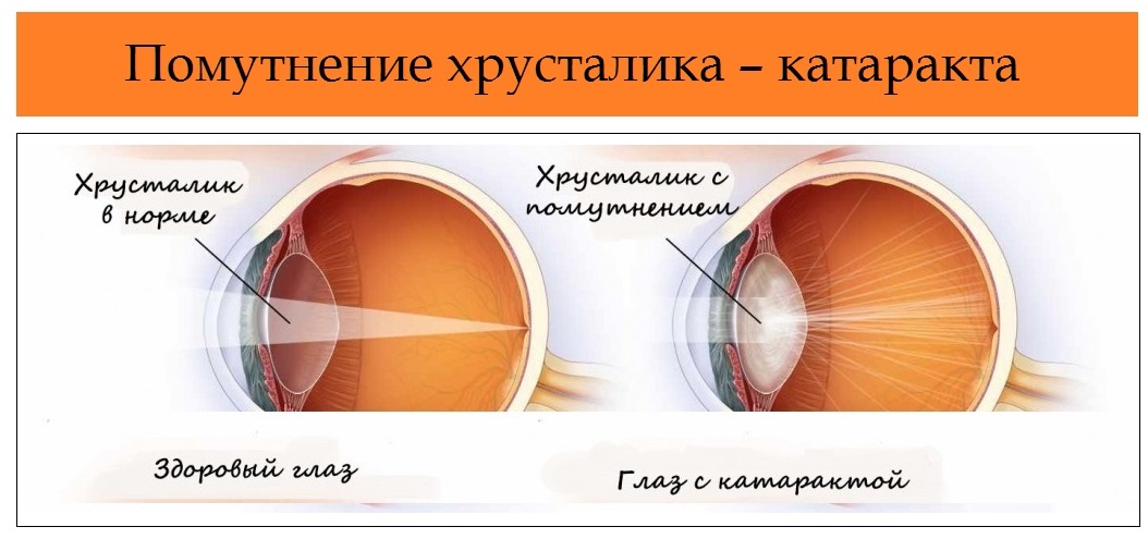 После операции катаракты какие ограничения и сроки