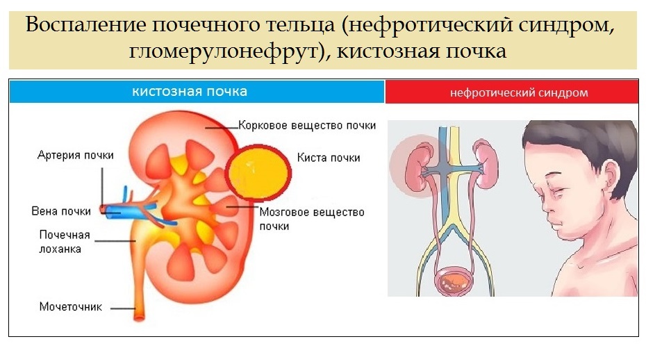 Ісіну синдромы презентация