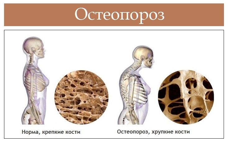 Психосоматика остеопороз поясничного отдела позвоночника