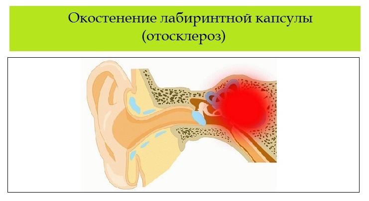 Психосоматика отосклероз уха, причины, примеры