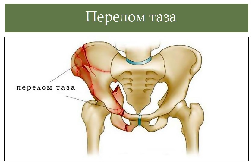 Переломы костей таза презентация