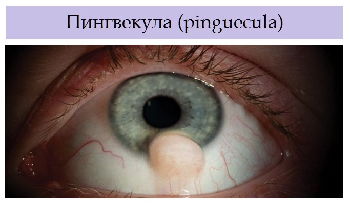 Психосоматика пингвекула глаза, причины, примеры