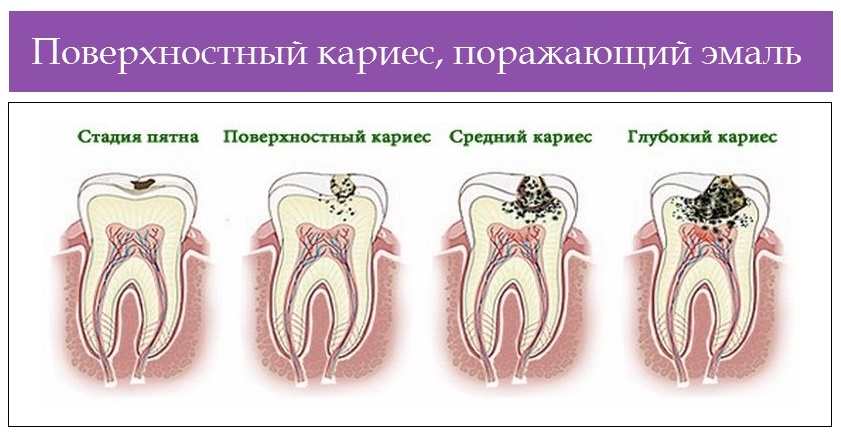 Стадии кариеса. Поверхностная стадия кариеса. Начальный поверхностный средний и глубокий кариес. Гаяаоьная мтадоя Кариема.