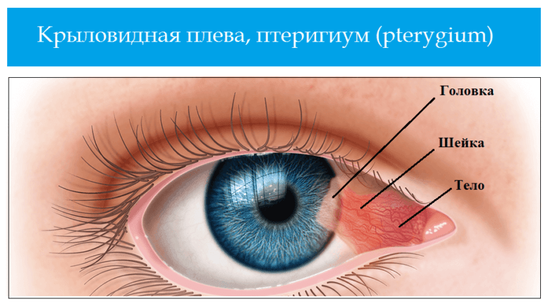 Психосоматика птеригиум глаза, причины, примеры