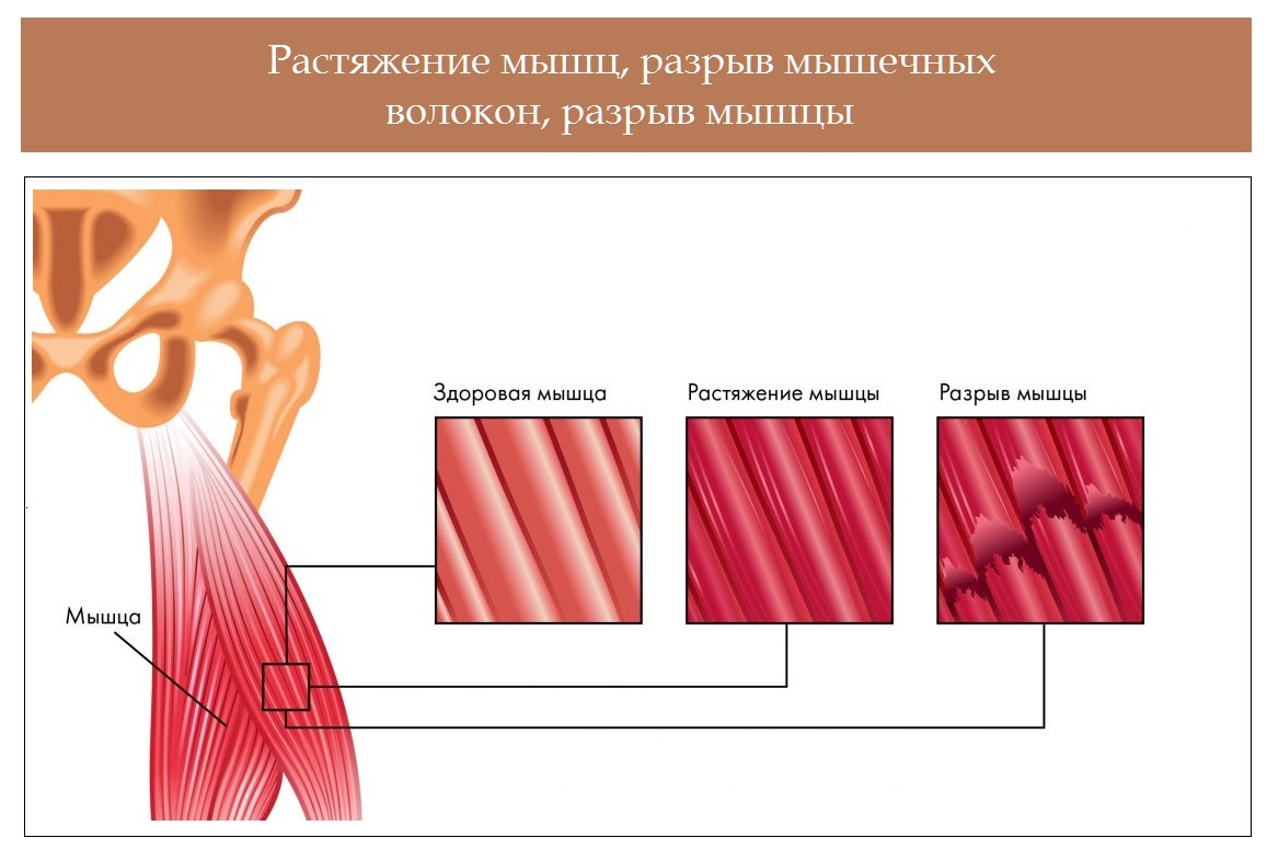 Лечение частичного разрыва мышц. Разрыв мышечных волокон. Микроразрывы мышечных волокон.