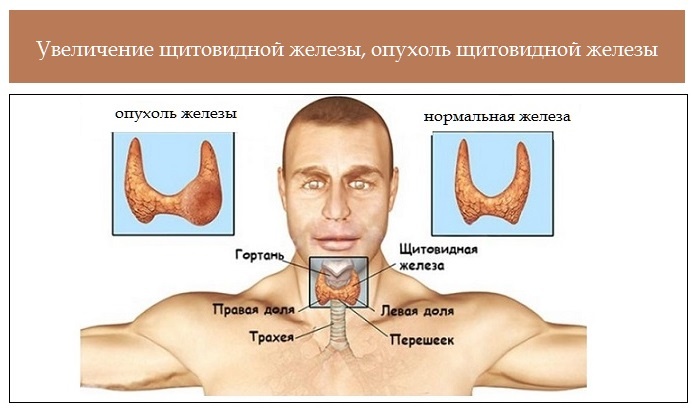 Психосоматика щитовидная железа, причины увеличения