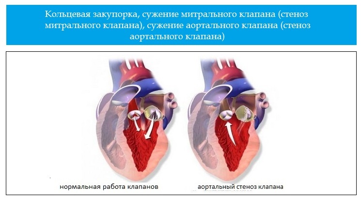 Психосоматика стеноз аортального клапана сердца, причины