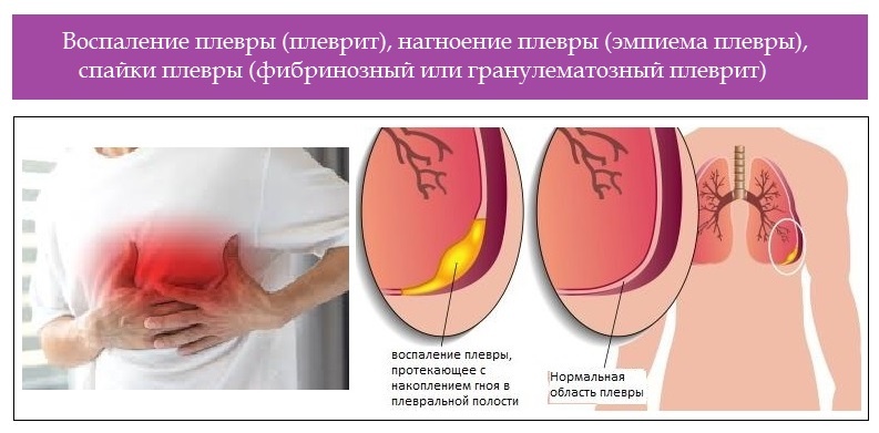 Воспаление тест. Воспаление плевры симптомы. Воспаление плевры легких. Воспаление лепестков плевры.