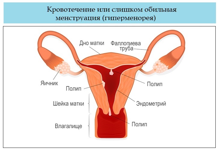 Психосоматика сильное кровотечение при менструации, причины