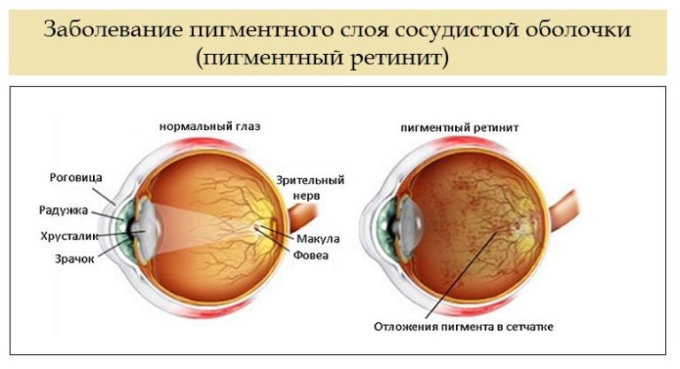 Психосоматика пигментный ретинит, причины, примеры