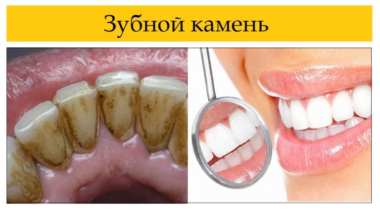 Зубной камень психосоматика, причины, примеры
