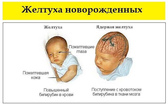 Желтуха у новорожденных психосоматика, причины